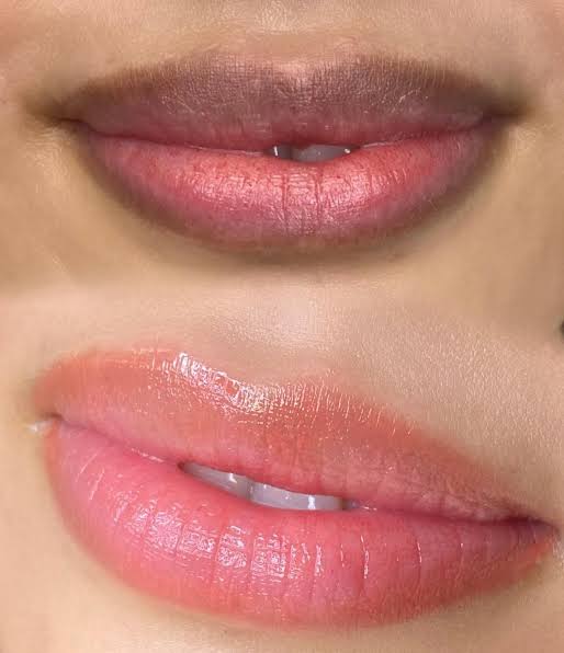 Lip Neutralization